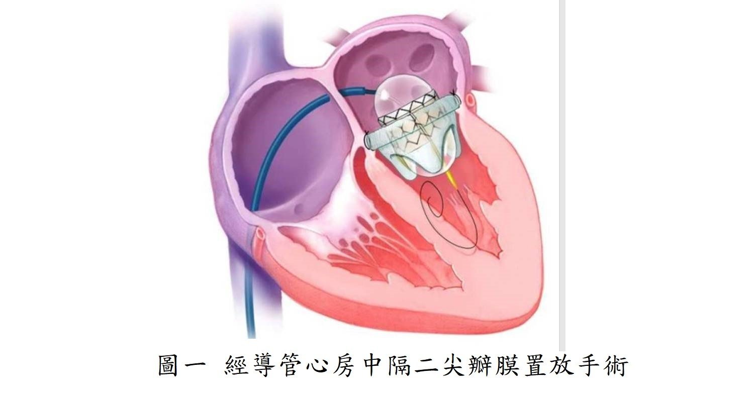 經導管心房中膈二尖瓣膜置放手術