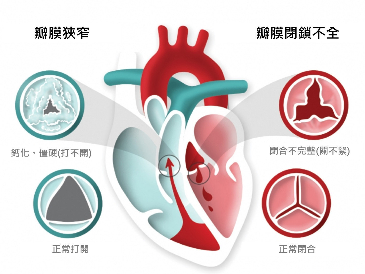 心臟瓣膜的功能就像只允許單向通行的「門」，而瓣膜疾病也可以用門壞掉的情形來舉例，通常可分為兩種狀況