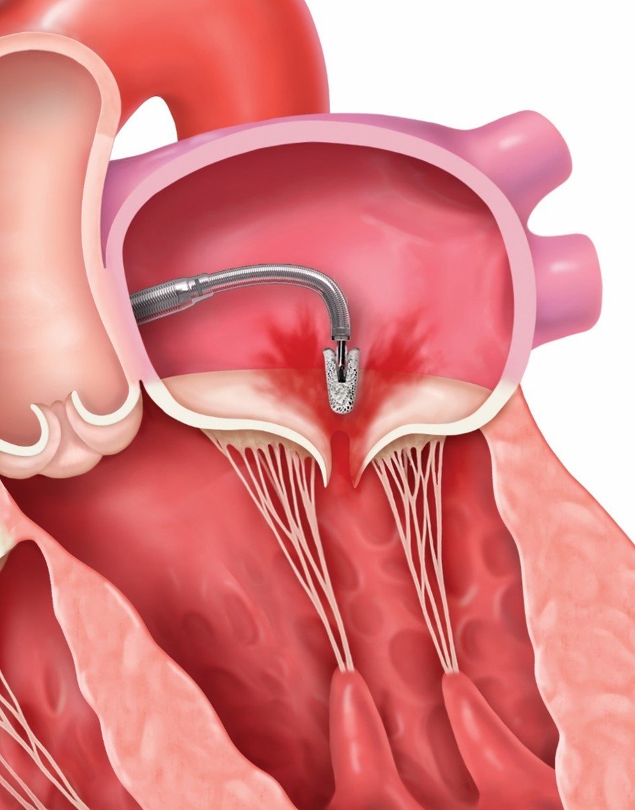 對患有嚴重二尖瓣膜逆流的患者，若外科手術的風險過高，或者合併嚴重心臟衰竭，醫師可能建議以導管方式修補瓣膜，也稱作「二尖瓣夾合術」
